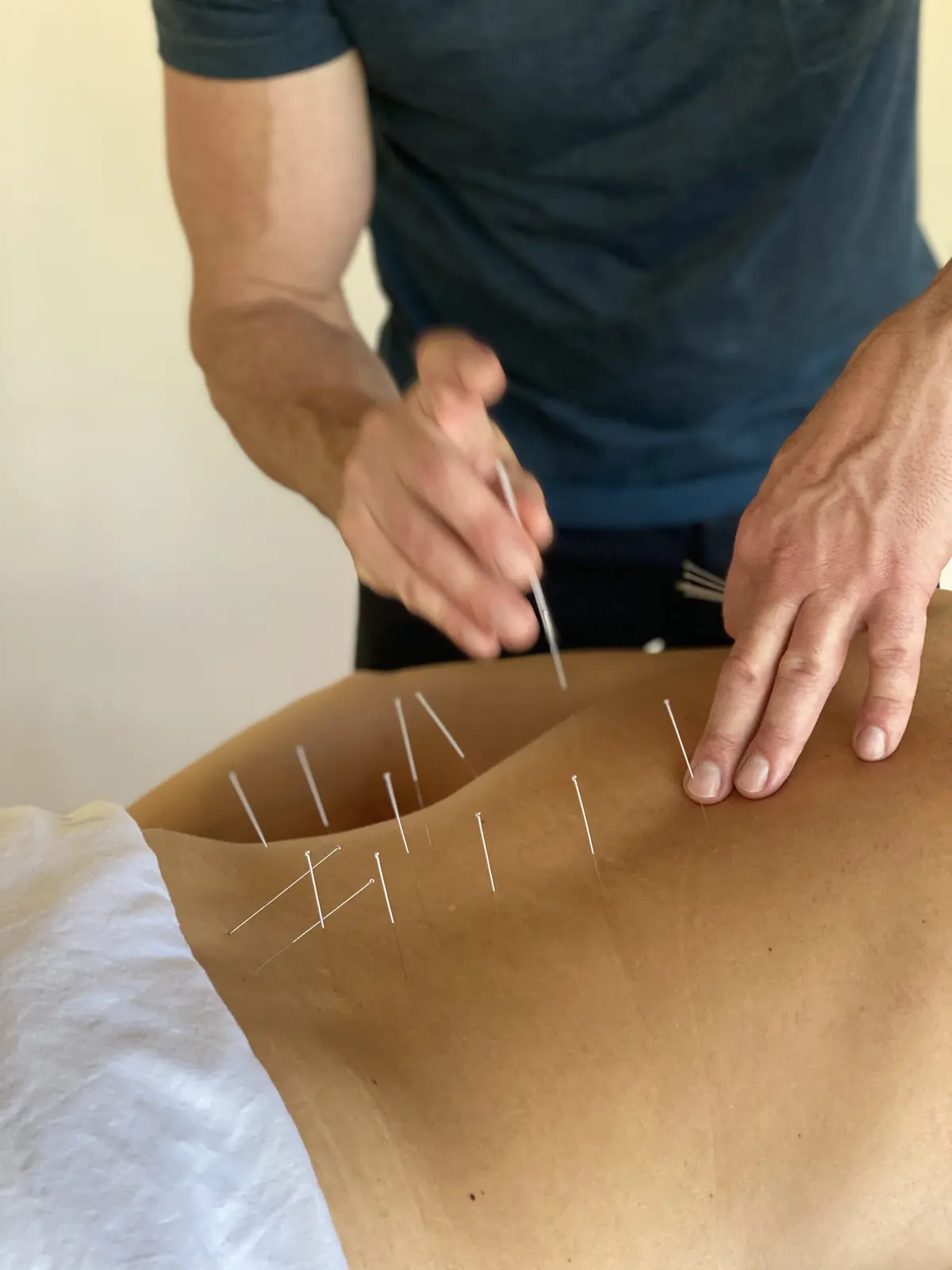 Acupuncture treatment at Back to Total Health Palm Springs